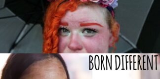 5 types of rare diseases that you never heard before!.. Rare disease