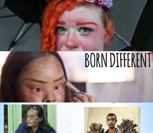 5 types of rare diseases that you never heard before!.. Rare disease