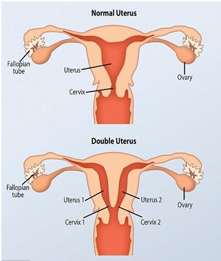 double uterus pictures