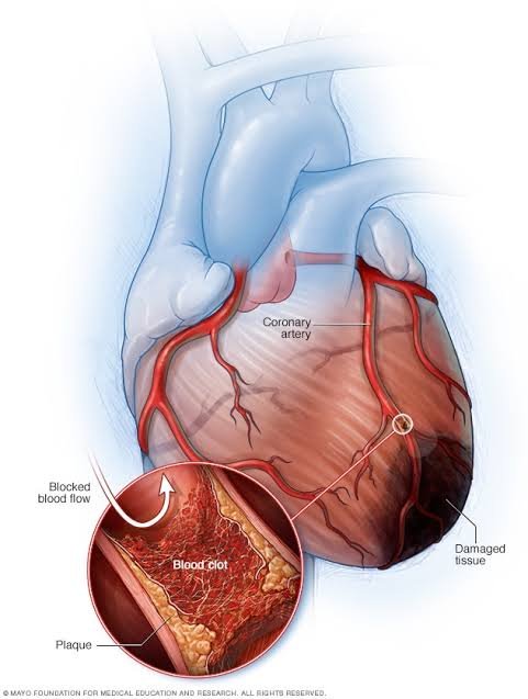 Having a chest pain? Can be a symptom of heart attack! Learn about the six symptoms of it 2 images 1 2
