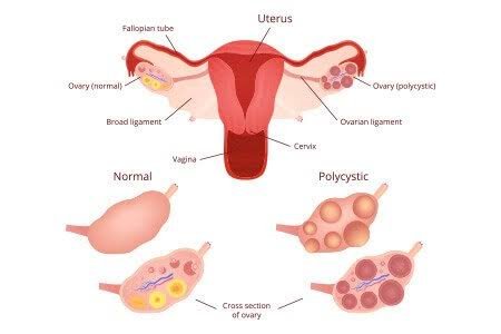 Suffering from PCOD? Then read this 5 question answered by gynocologist about PCOD! 1 images 14 1