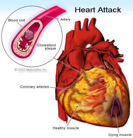Having a chest pain? Can be a symptom of heart attack! Learn about the six symptoms of it 1 images 18