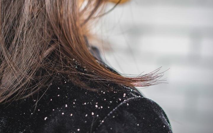 woman hair with dandruff falling on shoulders