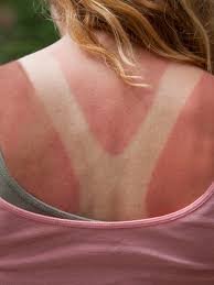 How can you protect yourself from Sunburn? Learn what Shahnaz Husain speaks about it! 2 download 2 2