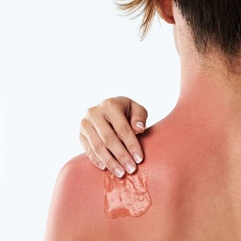 How can you protect yourself from Sunburn? Learn what Shahnaz Husain speaks about it!