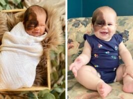 Little Winry : Little Winry has born with a rare birthmark, Her mother feels proud to share her photos… Little Winry : Little Winry has born with a rare birthmark, Her mother feels proud to share her photos...