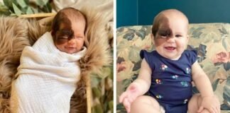 Little Winry : Little Winry has born with a rare birthmark, Her mother feels proud to share her photos… Little Winry : Little Winry has born with a rare birthmark, Her mother feels proud to share her photos...